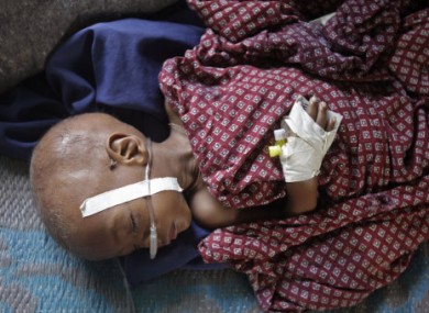 An unidentified child lies in a field hospital of Doctors Without Borders, MSF, in the town of Dadaab, Kenya.