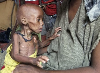 A malnourished child from southern Somalia in a makeshift shelter in a refugee camp in Mogadishu.