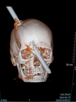 Tomogrophy scan shows the skull of the construction woker